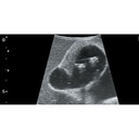 Abdominal Intraoperative and Laparoscopic Ultrasound Phantom