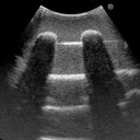 Ultrasound Echo Lung