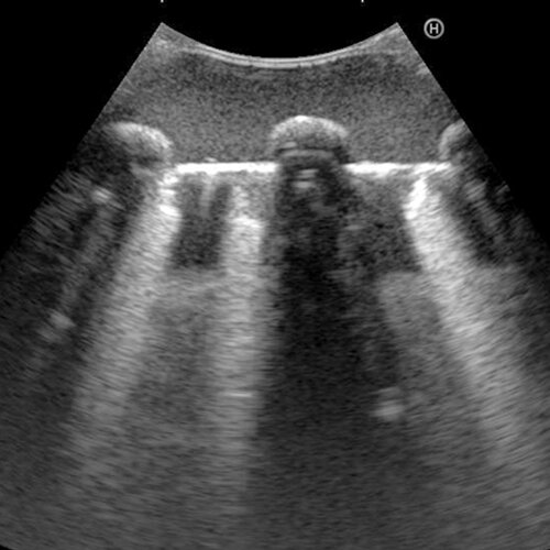 Ultrasound Echo Lung