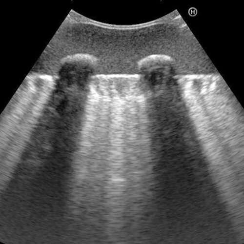 Ultrasound Echo Lung