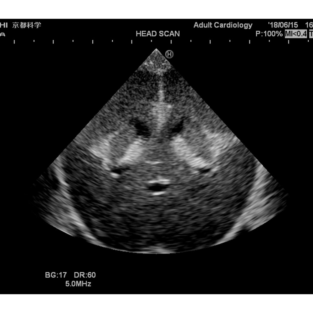 normal neonatal head ultrasound