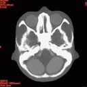 Angiographic CT Head Phantom ACS