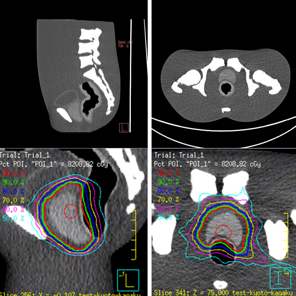 CT Prostate Phantom