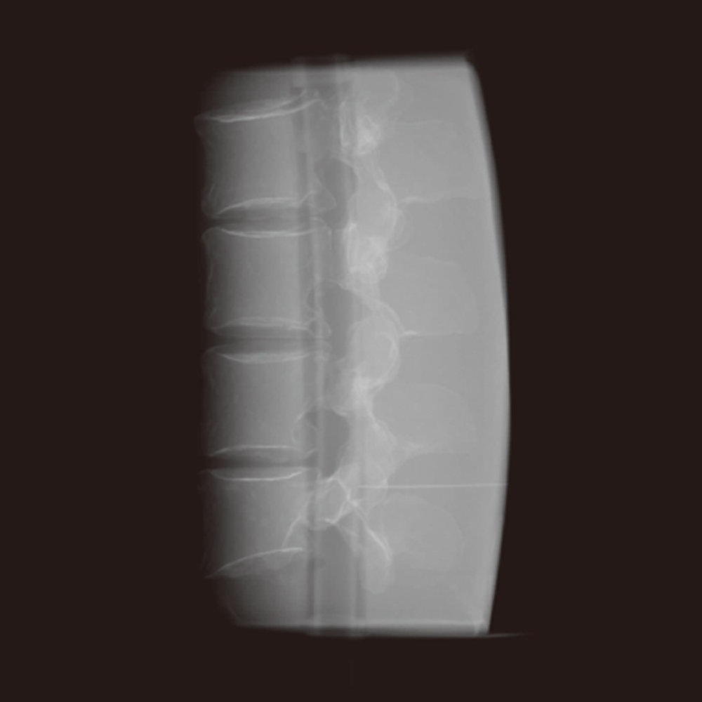 Lumbar Spine Fluoroscopy Training Phantom