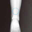 Paediatric Bone Fracture Phantom "PBU-70B"